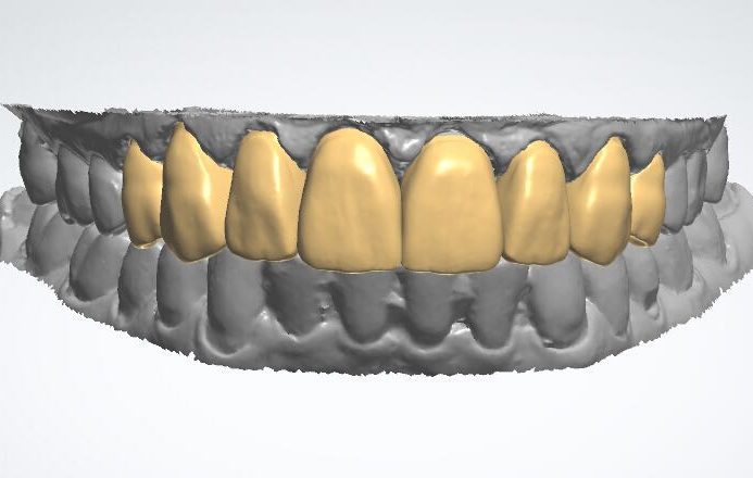 3Shape full crown CAD design case
