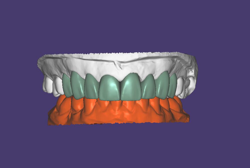 Exocad dental CAD design case