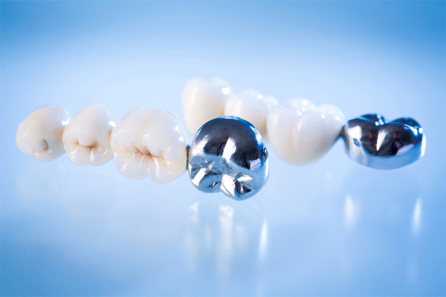 Metal crown and bridge dental restoration case