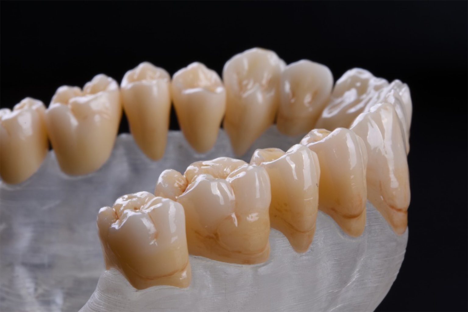 Full zirconia crown and bridge dental restoration case