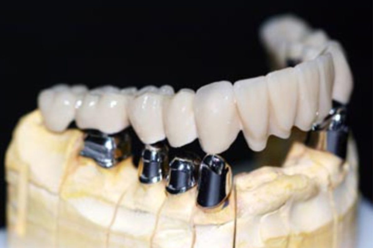 Custom titanium implant with crown and bridge case