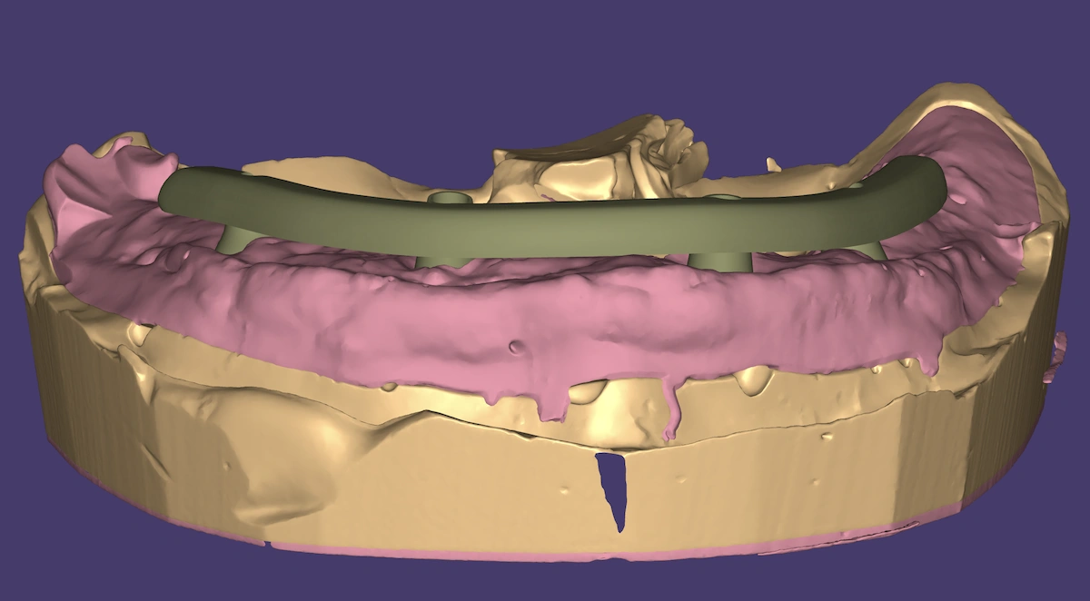 Hybrid implant full-arch CAD design shown in dental CAD software