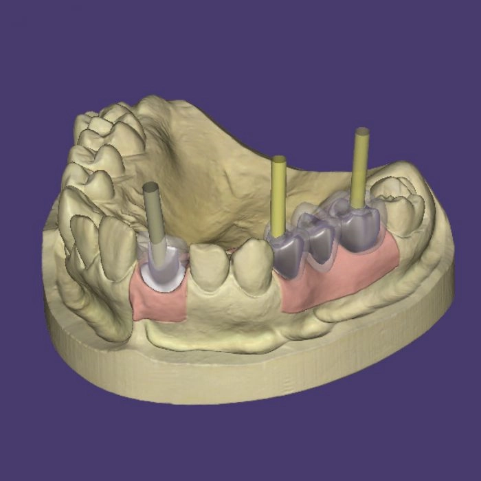 Implant bridge CAD design shown in dental CAD software