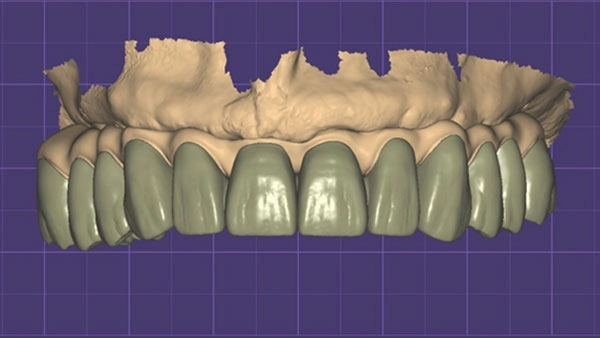 All-on-4 full-arch CAD design shown in dental CAD software