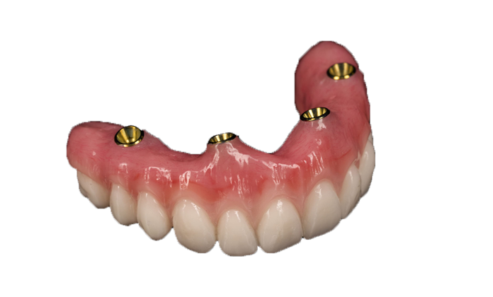 Finished All-on-4 full-arch implant restoration
