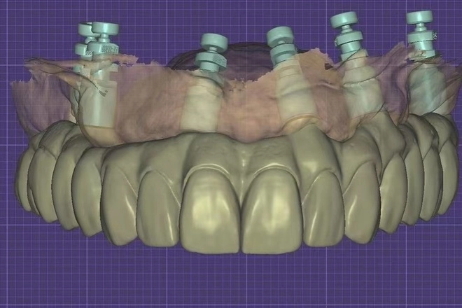 All-on-X PMMA full-arch CAD design shown in dental CAD software