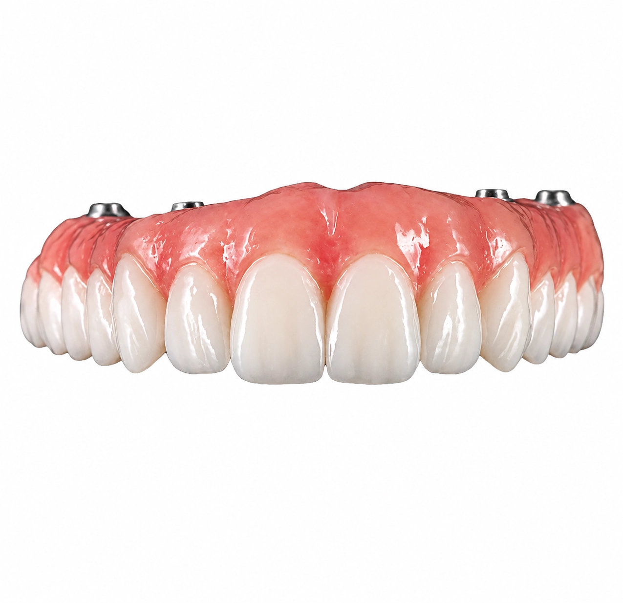 Finished All-on-X PMMA provisional full-arch restoration