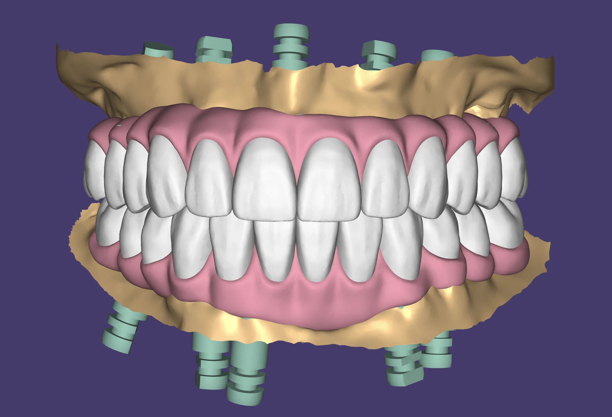 All-on-X zirconia full-arch CAD design shown in dental CAD software