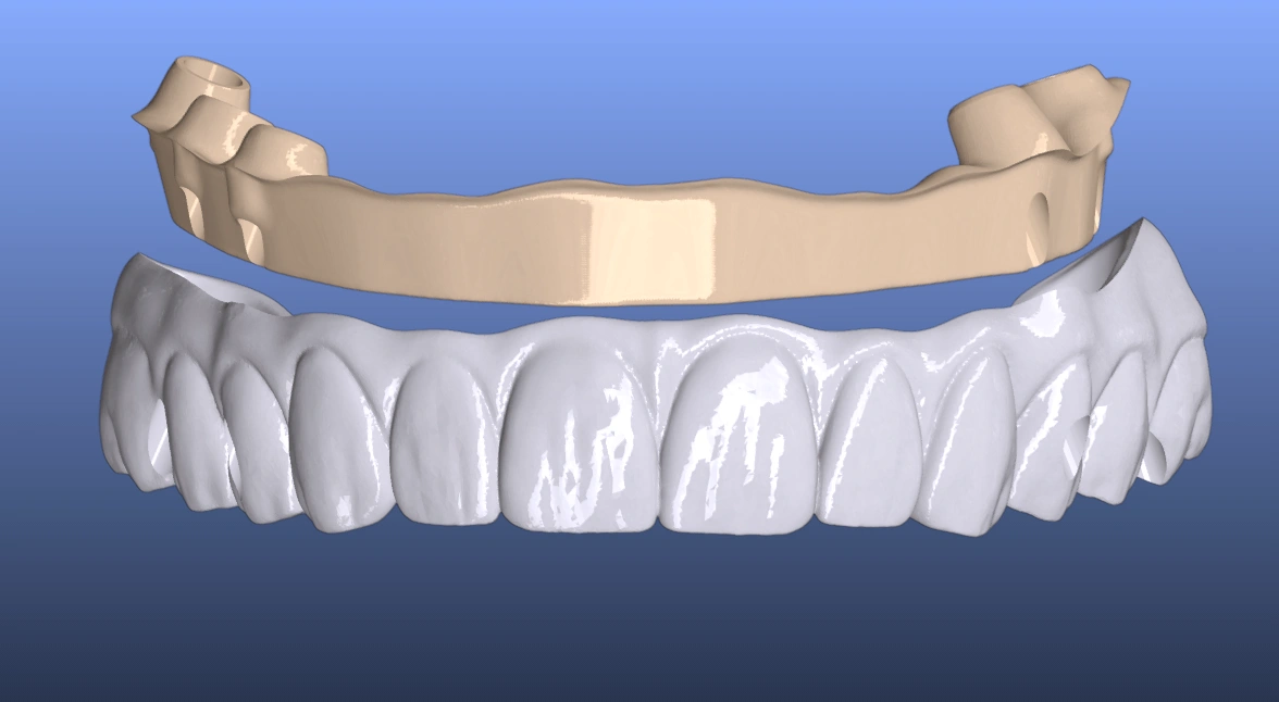 Blended I-Bar full-arch CAD design shown in dental CAD software