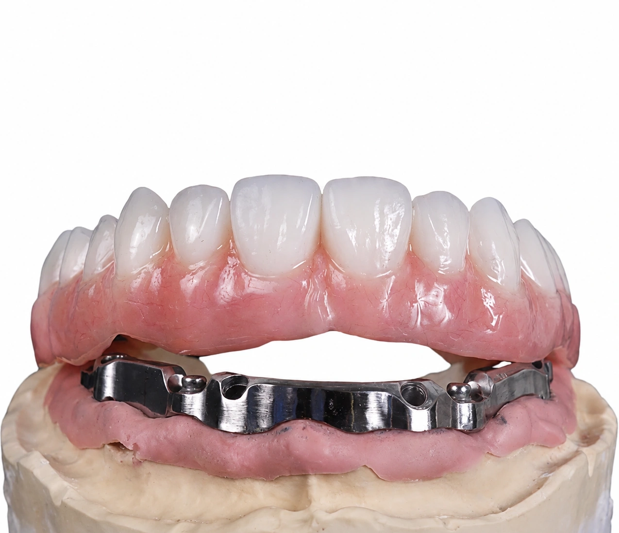 Finished Blended I-Bar full-arch implant restoration