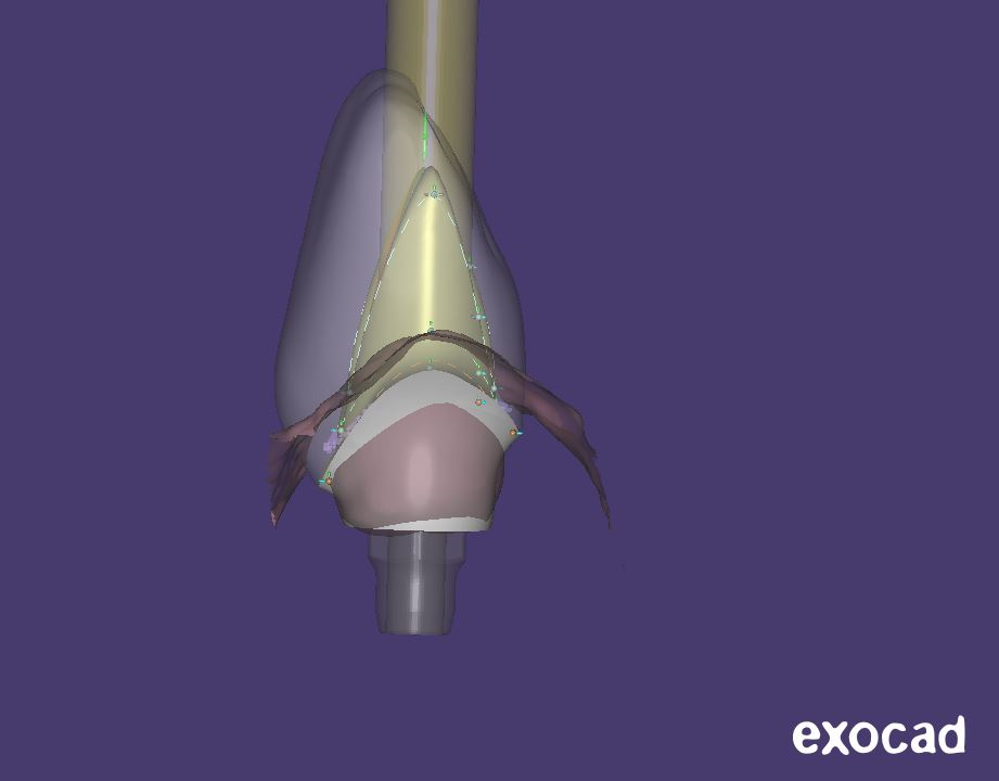 Custom implant abutment CAD design shown in dental CAD software