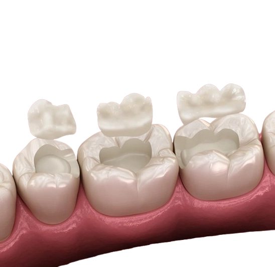 Finished dental inlay and onlay restorations