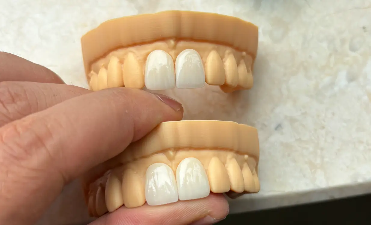 Finished dental veneer restoration