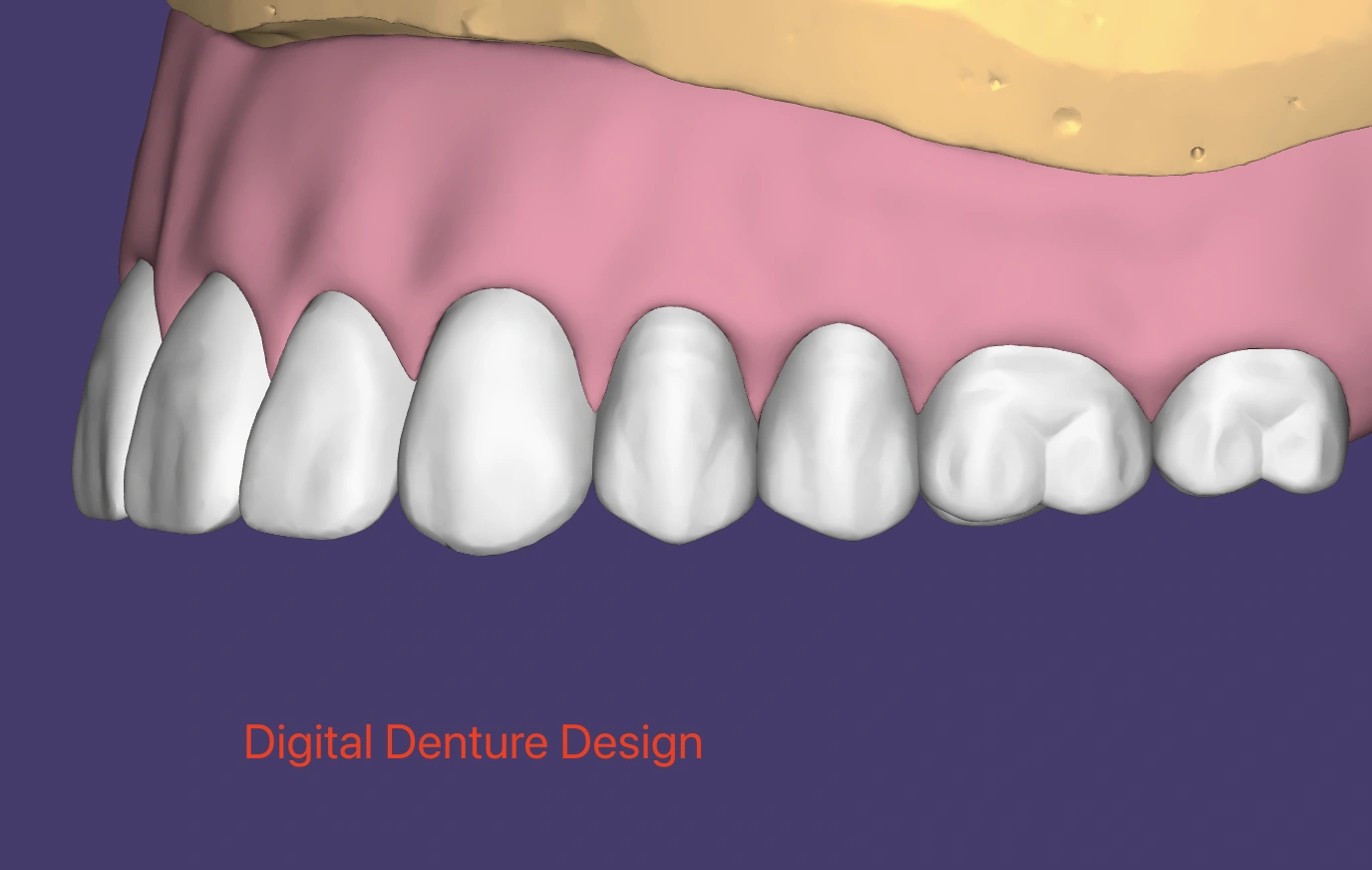Digital denture CAD design shown in dental CAD software