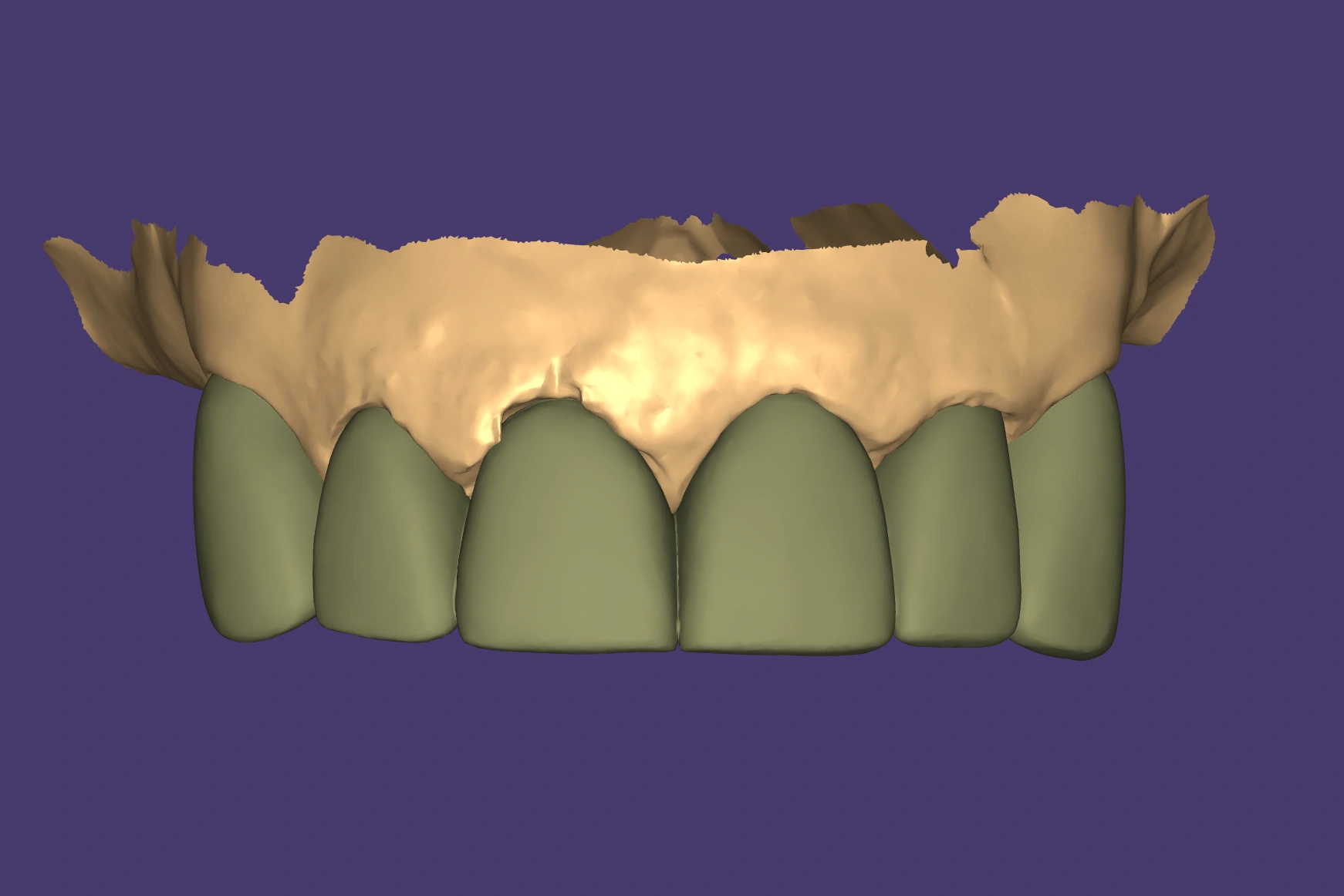 E.max crown CAD design shown in dental design software