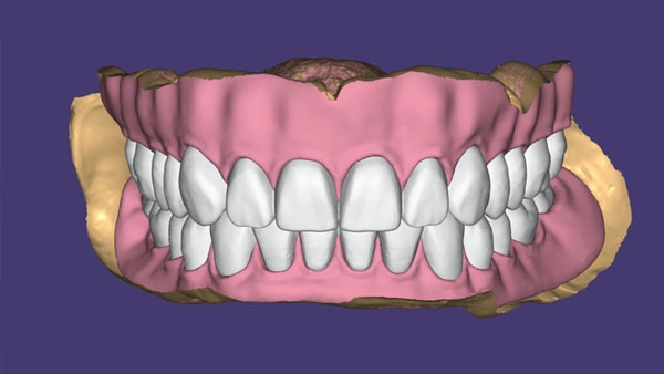 Full denture CAD design shown in dental CAD software