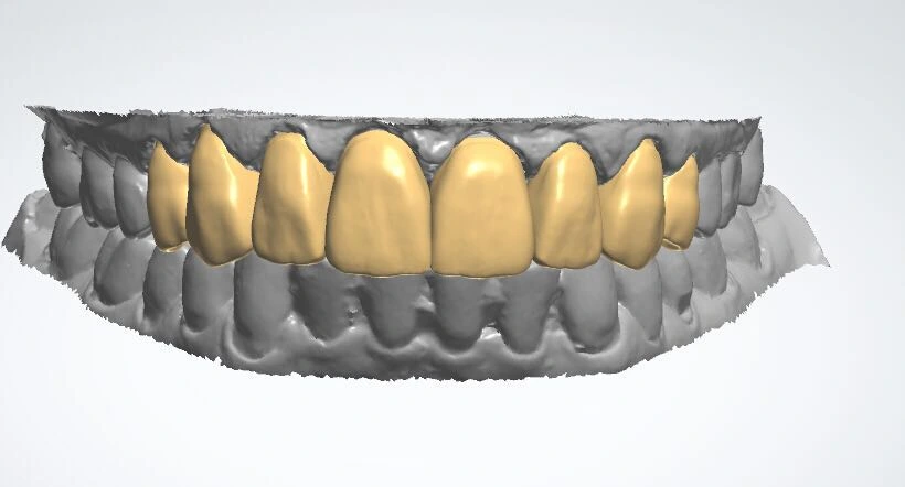 Full zirconia crown CAD design shown in dental design software
