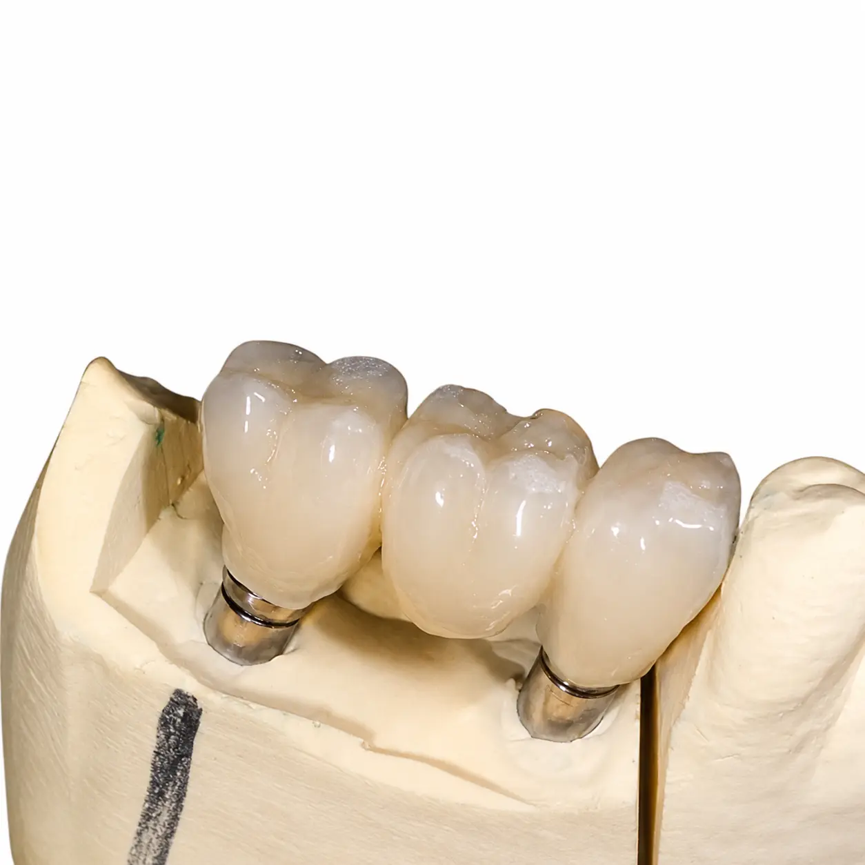 Finished implant-supported bridge restoration