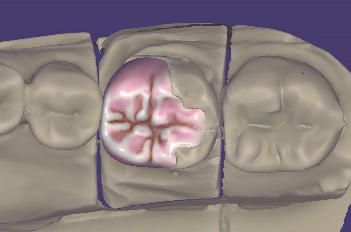 Dental inlay and onlay CAD design shown in dental design software