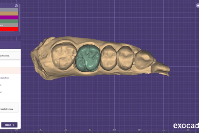Full metal crown CAD design shown in dental design software