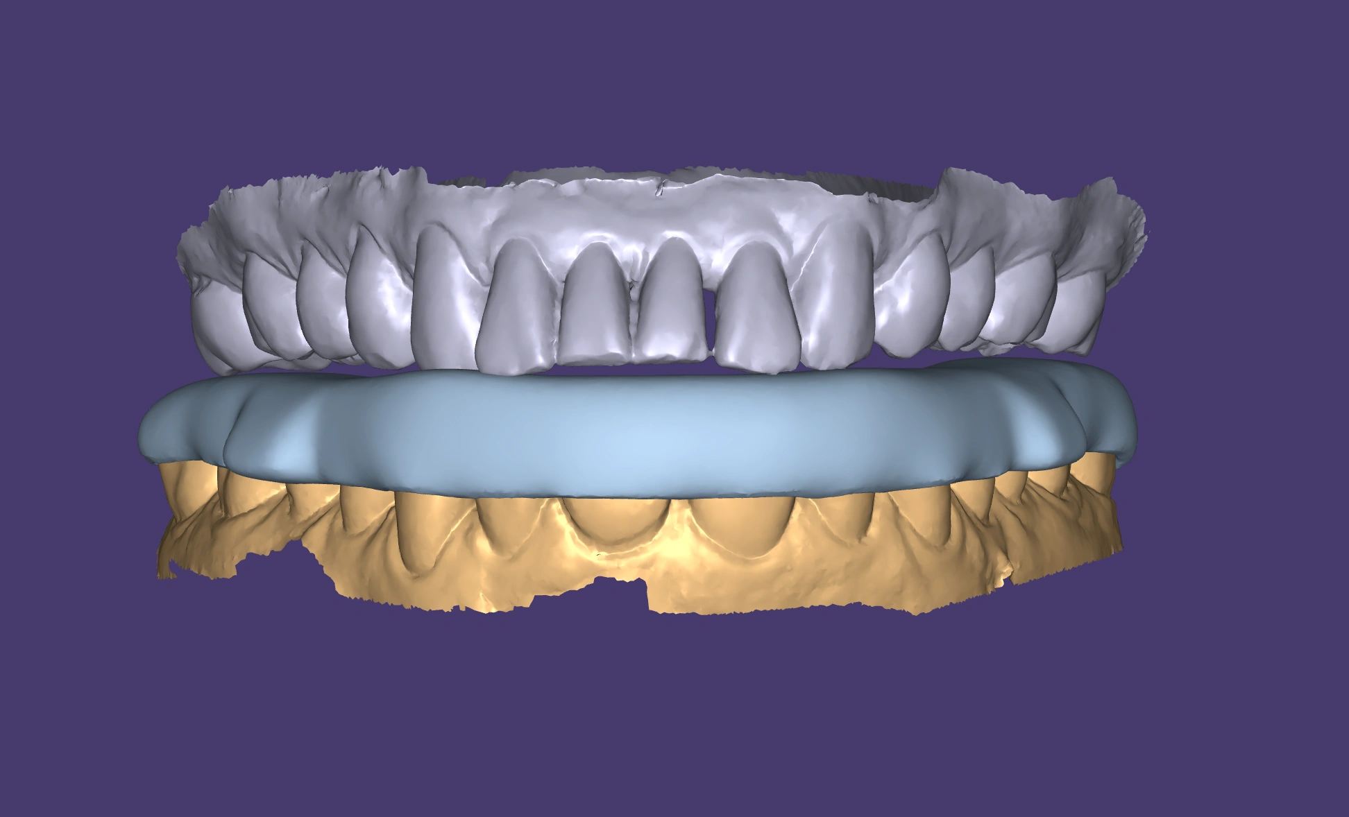 Night guard CAD design shown in dental CAD software