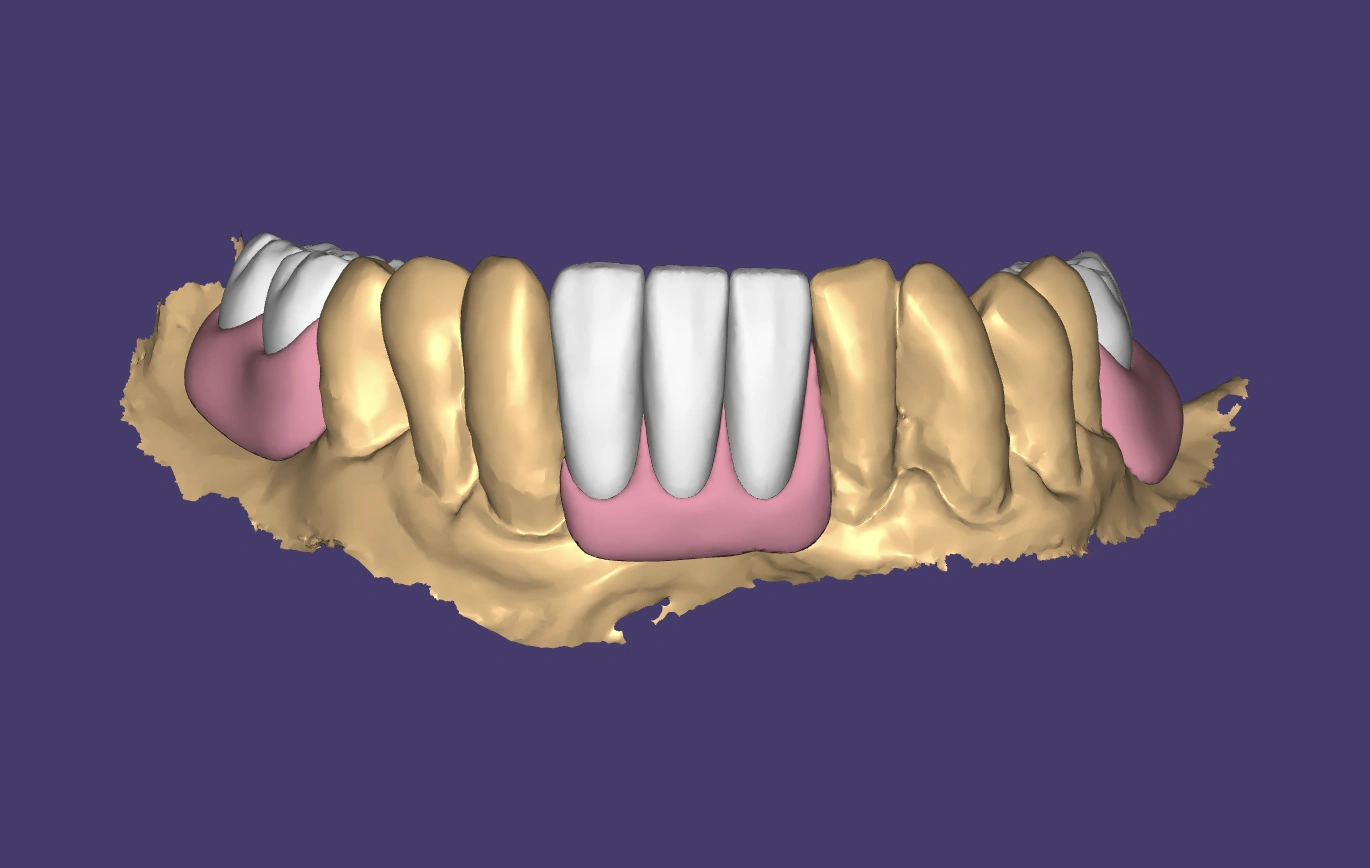 Partial denture CAD design shown in dental CAD software