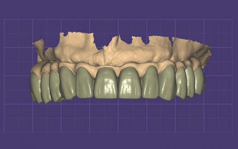 PFM crown CAD design shown in dental design software