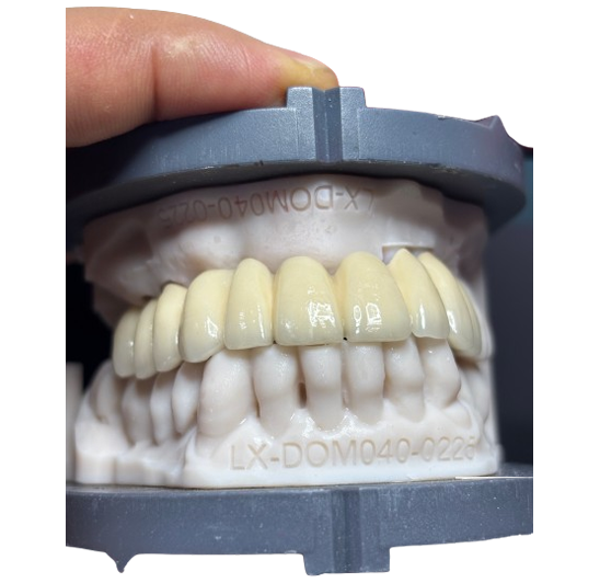 Finished PFM crown restoration