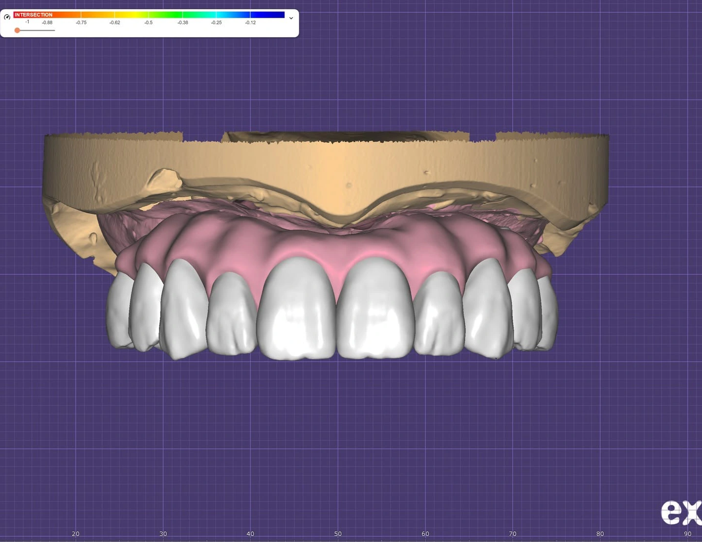 PMMA bridge CAD design shown in dental design software
