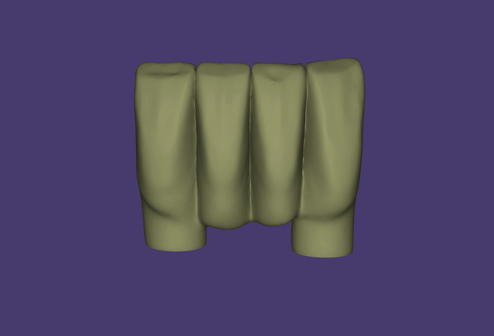 Screw-retained implant crown CAD design shown in dental CAD software