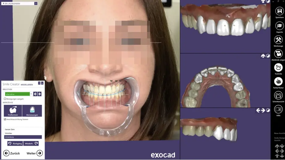 Exocad smile design case showing facial analysis and dental CAD workflow