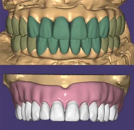 Full-arch dental CAD design case showing tooth setup and gingiva design