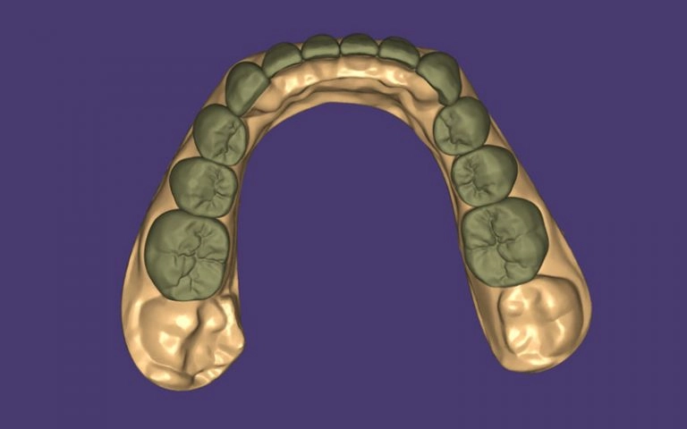 Dental veneer CAD design shown in dental design software