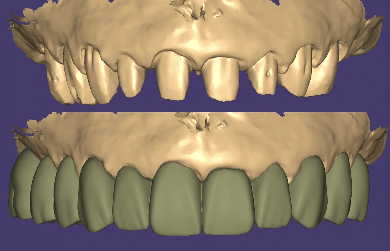 Zirconia bridge CAD design shown in dental design software