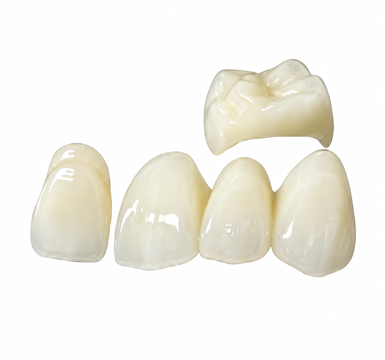 Finished zirconia bridge restoration